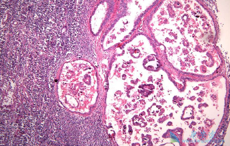 良性肿瘤;肿瘤 良性肿瘤;肿瘤