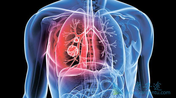 治疗肺癌;肺癌还能活多久 治疗肺癌;肺癌还能活多久