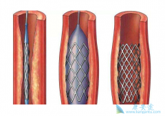 ����֧��������������Ѫ�ܵĻ��� ��ô����֧����Ч��