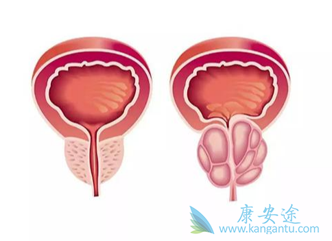 前列腺癌;恶性肿瘤 前列腺癌;恶性肿瘤