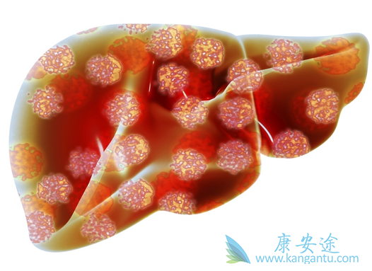 肝癌;治疗肝癌 肝癌;治疗肝癌