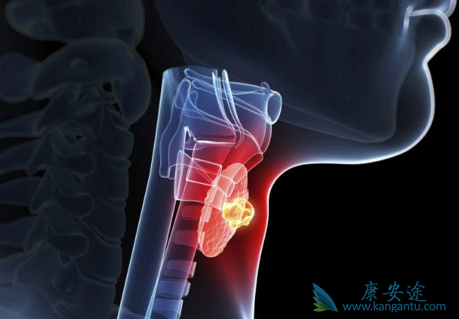 甲状腺癌 甲状腺癌