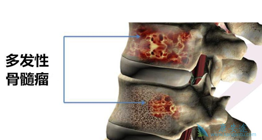 多发性骨髓瘤 多发性骨髓瘤