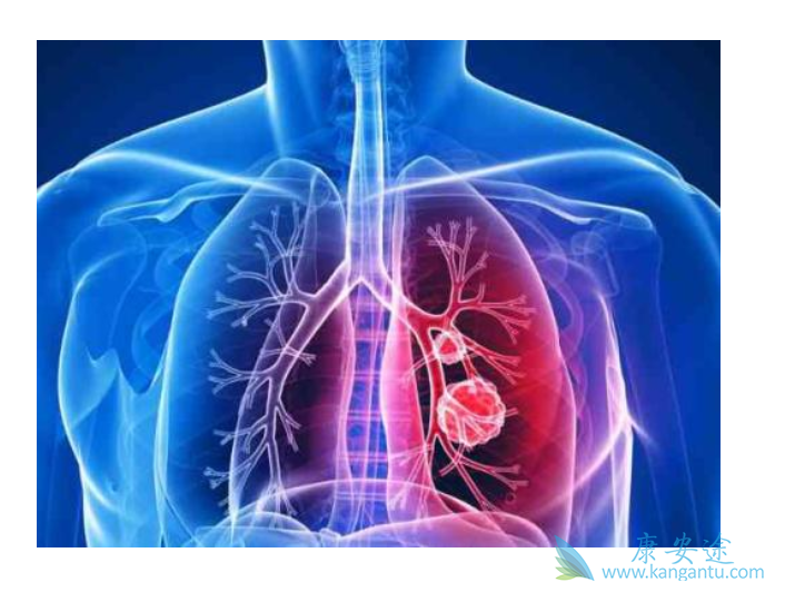 转移性肺癌 转移性肺癌