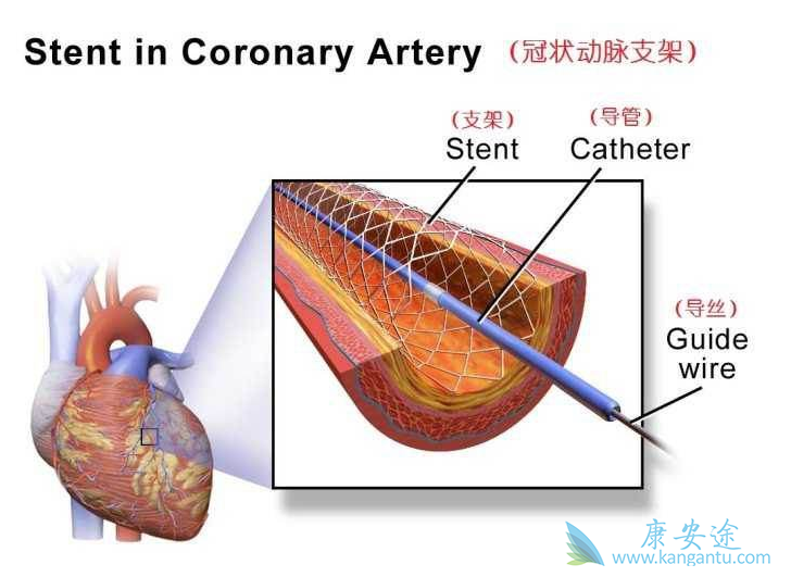 心脏支架 心脏支架