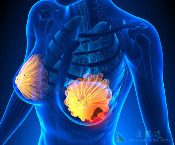 晚期乳腺癌 晚期乳腺癌