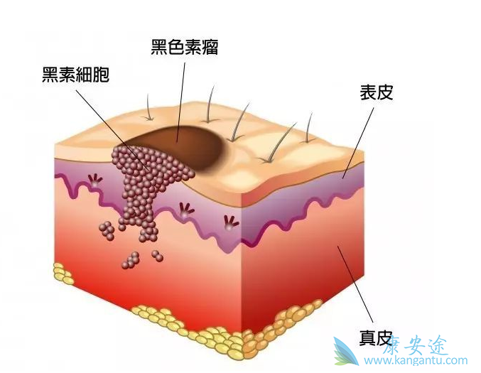 黑色素瘤细胞 黑色素瘤细胞