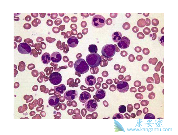 慢性粒细胞白血病 慢性粒细胞白血病