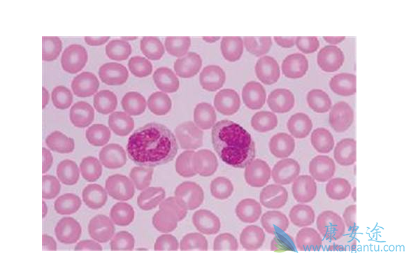 慢性粒细胞性白血病 慢性粒细胞性白血病