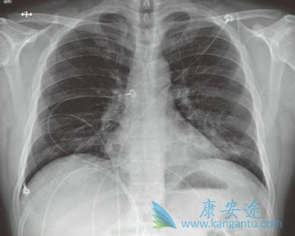瑞德西韦 瑞德西韦