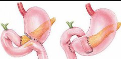 科学家正在研究致命胰腺癌的治疗方法
